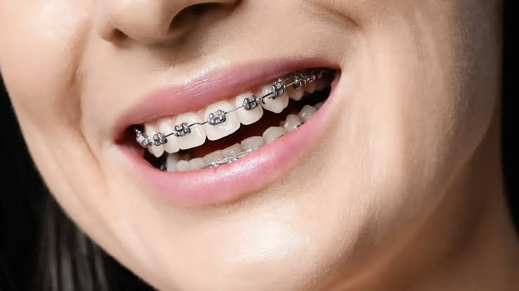 Braces